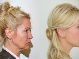 Plastická operácia tváre - Facelift a YES Lifting