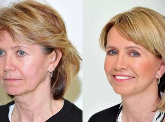 PREMENA: Plastická operácia tváre - Facelift a viečka - pani Zdena na Klinike YES VISAGE