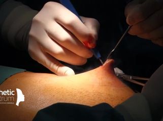 Zmenšenie mužskej prsnej žľazy (gynekomastia)