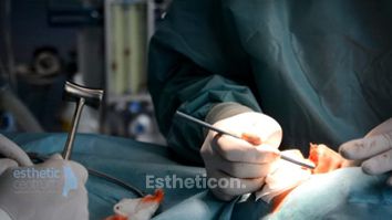 Rinoplastika