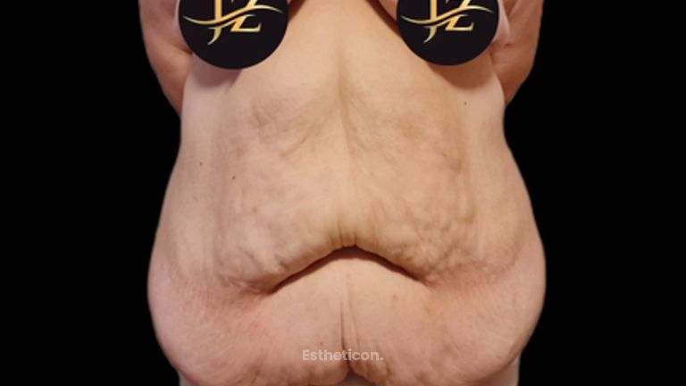 Abdominoplastika Fleur de Lis