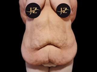 Abdominoplastika Fleur de Lis