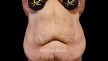 Abdominoplastika Fleur de Lis