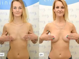 Ako sa plní sen…Zuzana Pyšná a zväčšenie pŕs