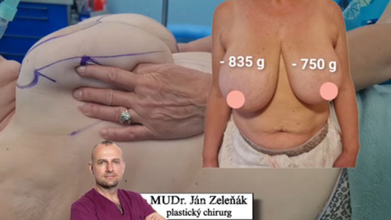 Redukčná mammaplastika