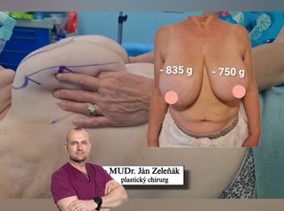 Redukčná mammaplastika