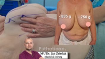 Redukčná mammaplastika